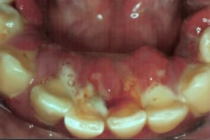 Severe periodontal infection